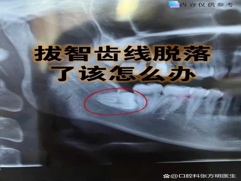 韦林顿确诊上唇部贯通伤;11、21牙半脱位;上颌前牙区牙槽骨骨折